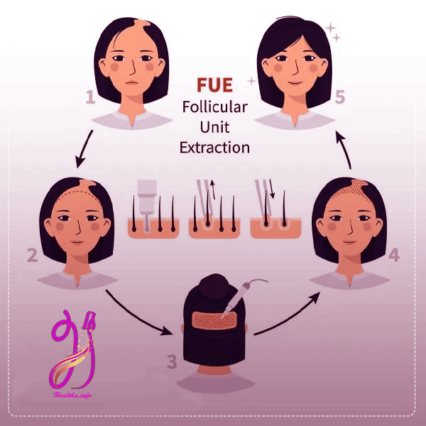 کاشت مو به روش FUE (Follicular Unit Extraction)